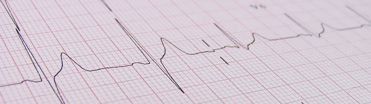 Arrhythmia Treatment Van Nuys | Sylmar | Sherman Oaks | Tarzana